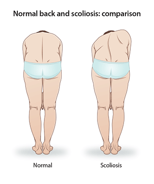 Scoliosis Treatment Options
